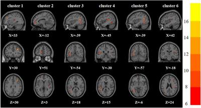 Altered Brain Function in First-Episode and Recurrent Depression: A Resting-State Functional Magnetic Resonance Imaging Study